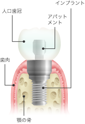 implant_images_01