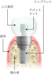 implant_images_01 implant_images_01