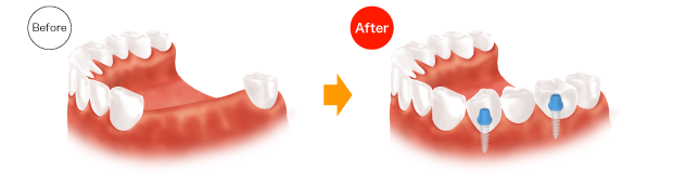 implant_images_03